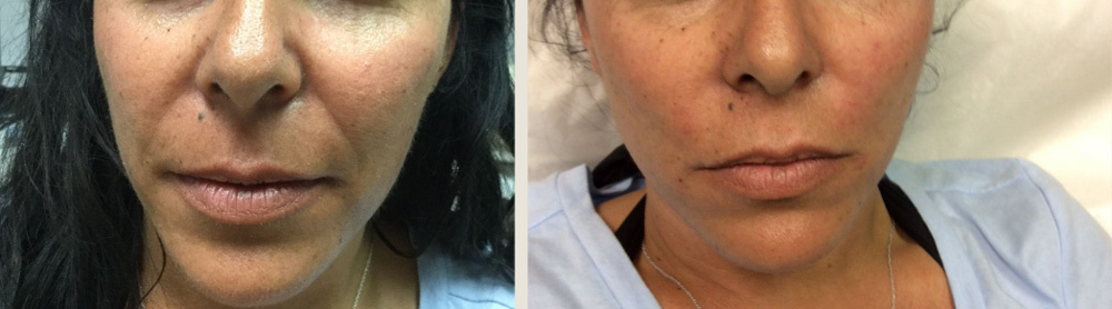 Dermal Fillers Before and After Photo by Dr. Frankel in Manasquan, NJ
