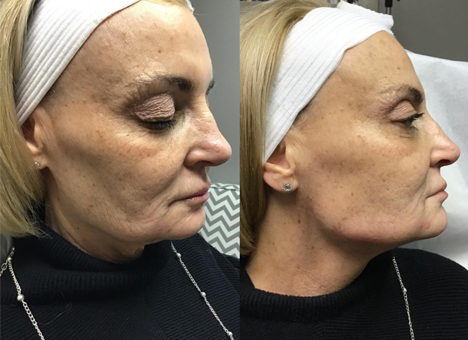 Dermal Fillers Before and After Photo by Dr. Frankel in Manasquan, NJ