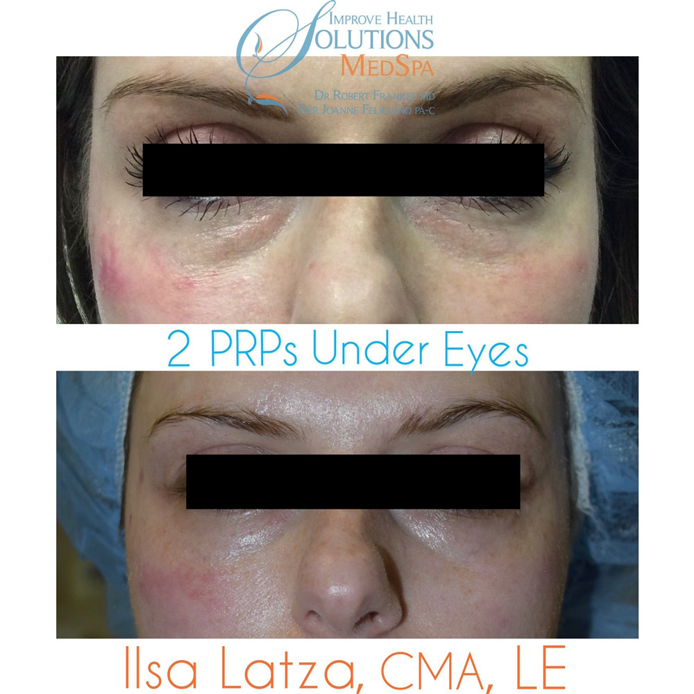 PRP Before and After Photo by Dr. Frankel in Manasquan, NJ