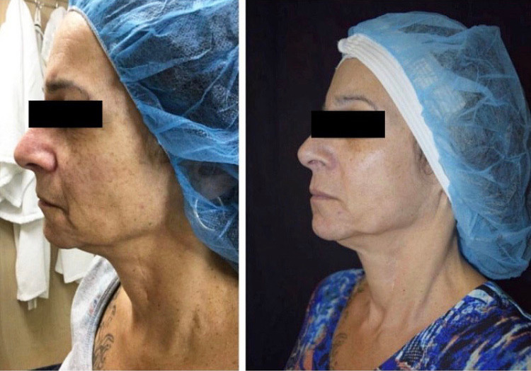 PRP Before and After Photo by Dr. Frankel in Manasquan, NJ