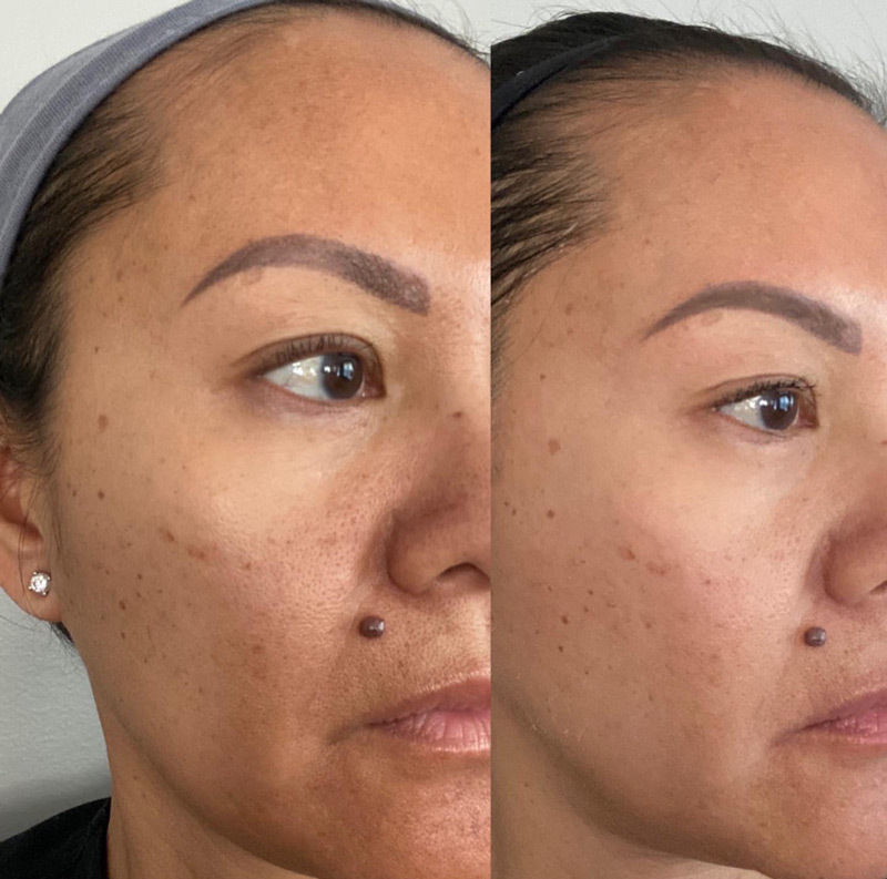 VI Peel Before and After Photo by Dr. Frankel in Manasquan, NJ