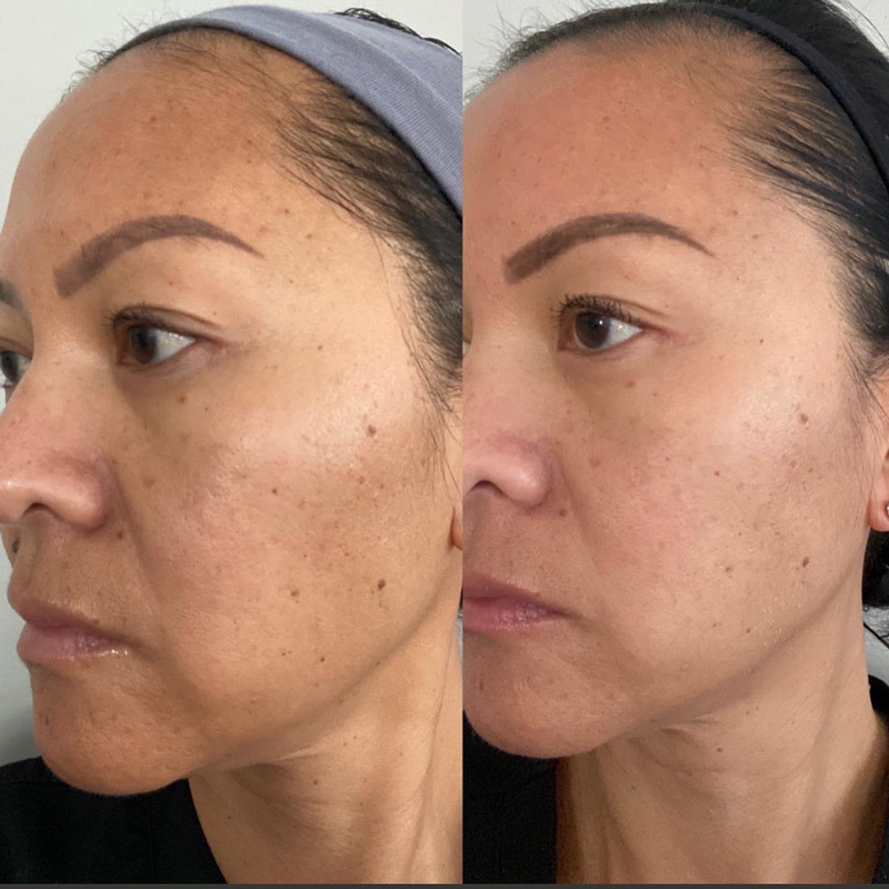 VI Peel Before and After Photo by Dr. Frankel in Manasquan, NJ