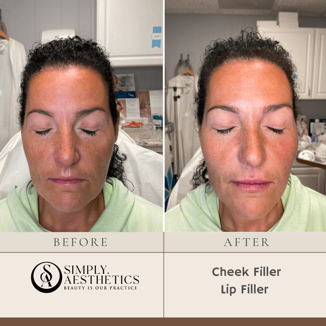 Cheek Filler Lip Filler Before and After Photo by Dr. Frankel in Manasquan, NJ