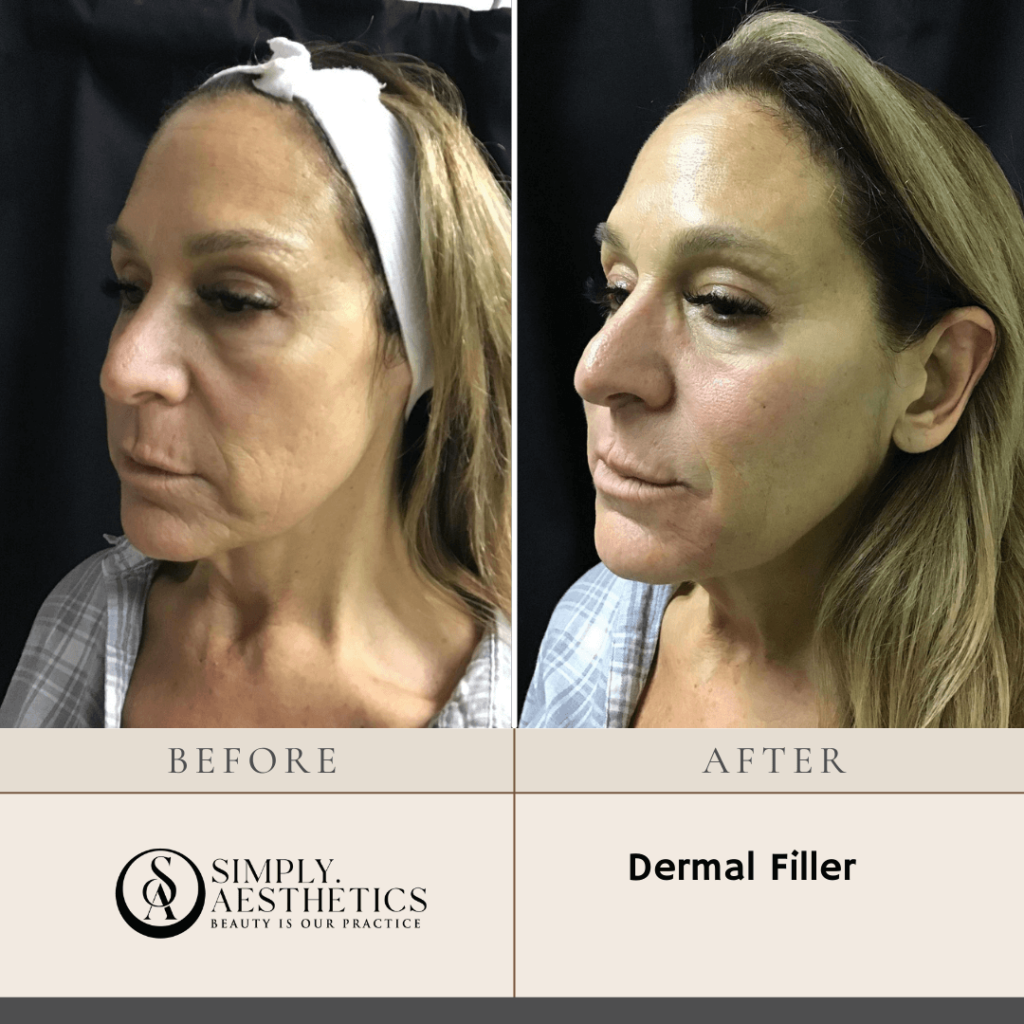 Dermal Filler Before and After Photo by Dr. Frankel in Manasquan, NJ