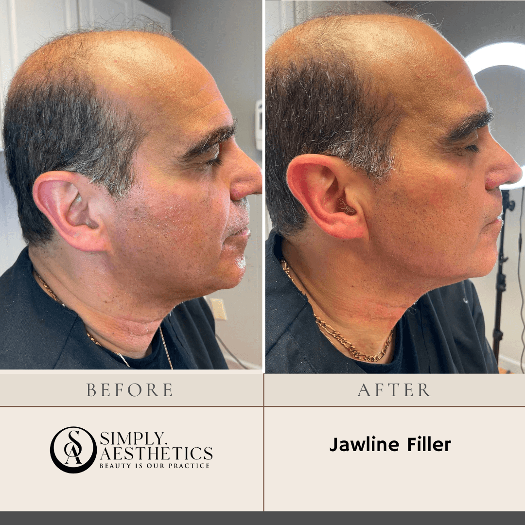Jawline Filler Before and After Photo by Dr. Frankel in Manasquan, NJ