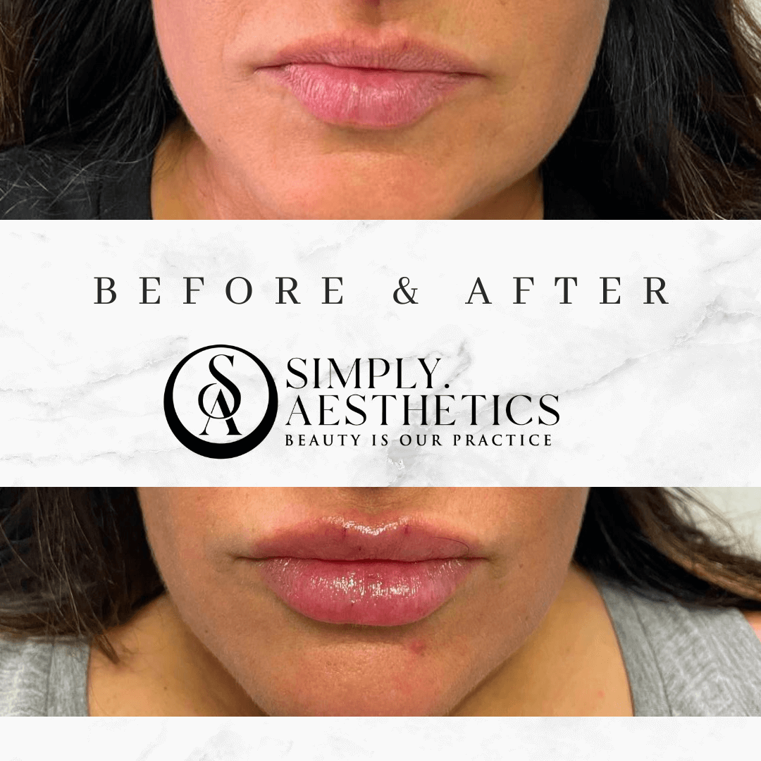 Lip Fillers Before and After Photo by Dr. Frankel in Manasquan, NJ