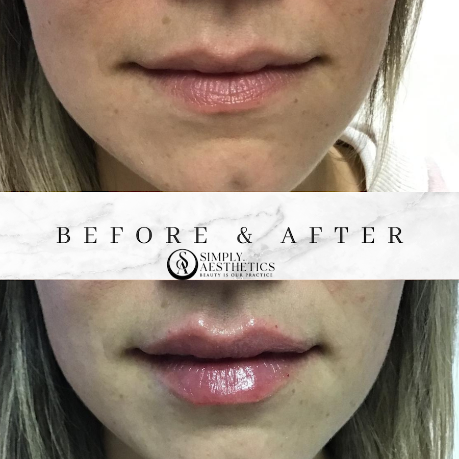 Juvéderm Volbella Before and After Photo by Dr. Frankel in Manasquan, NJ