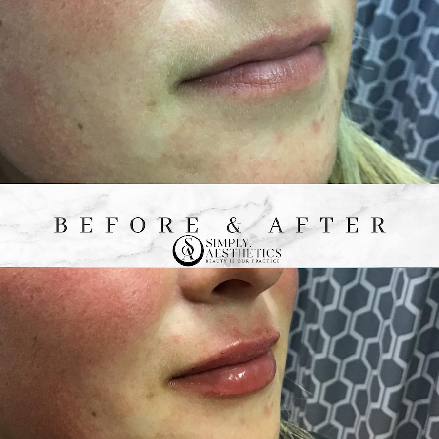 Juvéderm Volbella Before and After Photo by Dr. Frankel in Manasquan, NJ