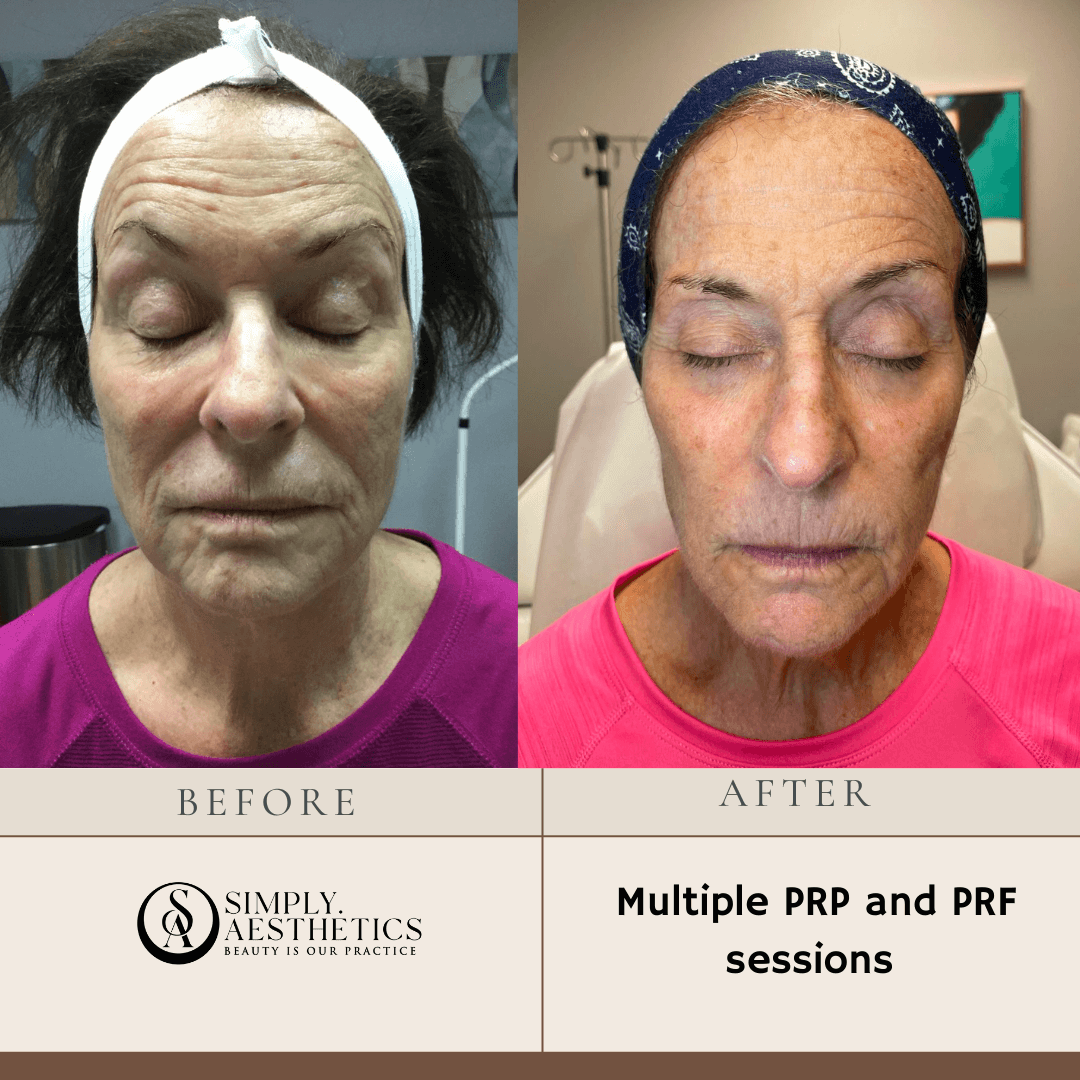 PRP and PRF Before and After Photo by Dr. Frankel in Manasquan, NJ