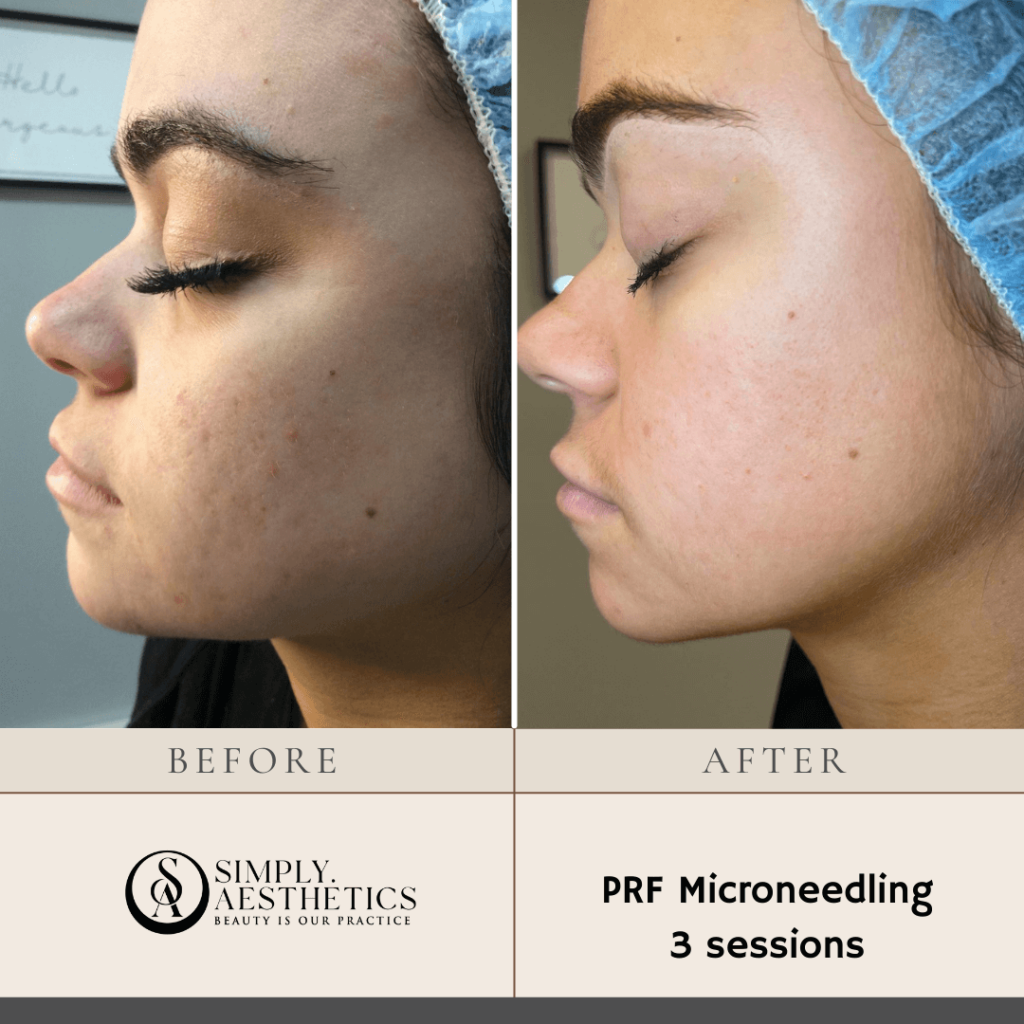 PRF Microneedling 3 sessions