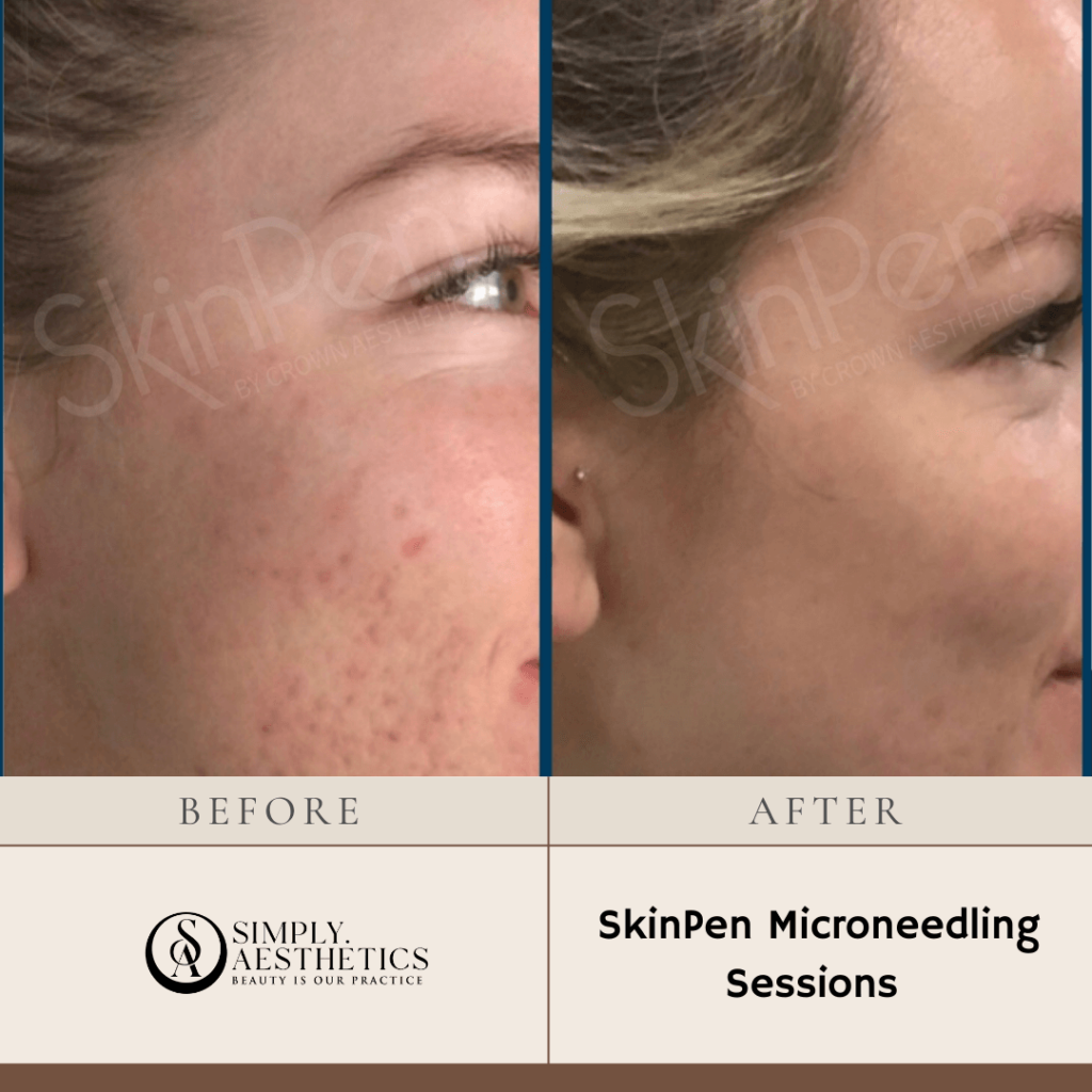 SkinPen Microneedling Before and After Photo by Dr. Frankel in Manasquan, NJ