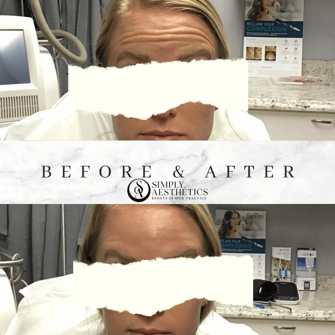 Botox Before and After Photo by Dr. Frankel in Manasquan, NJ