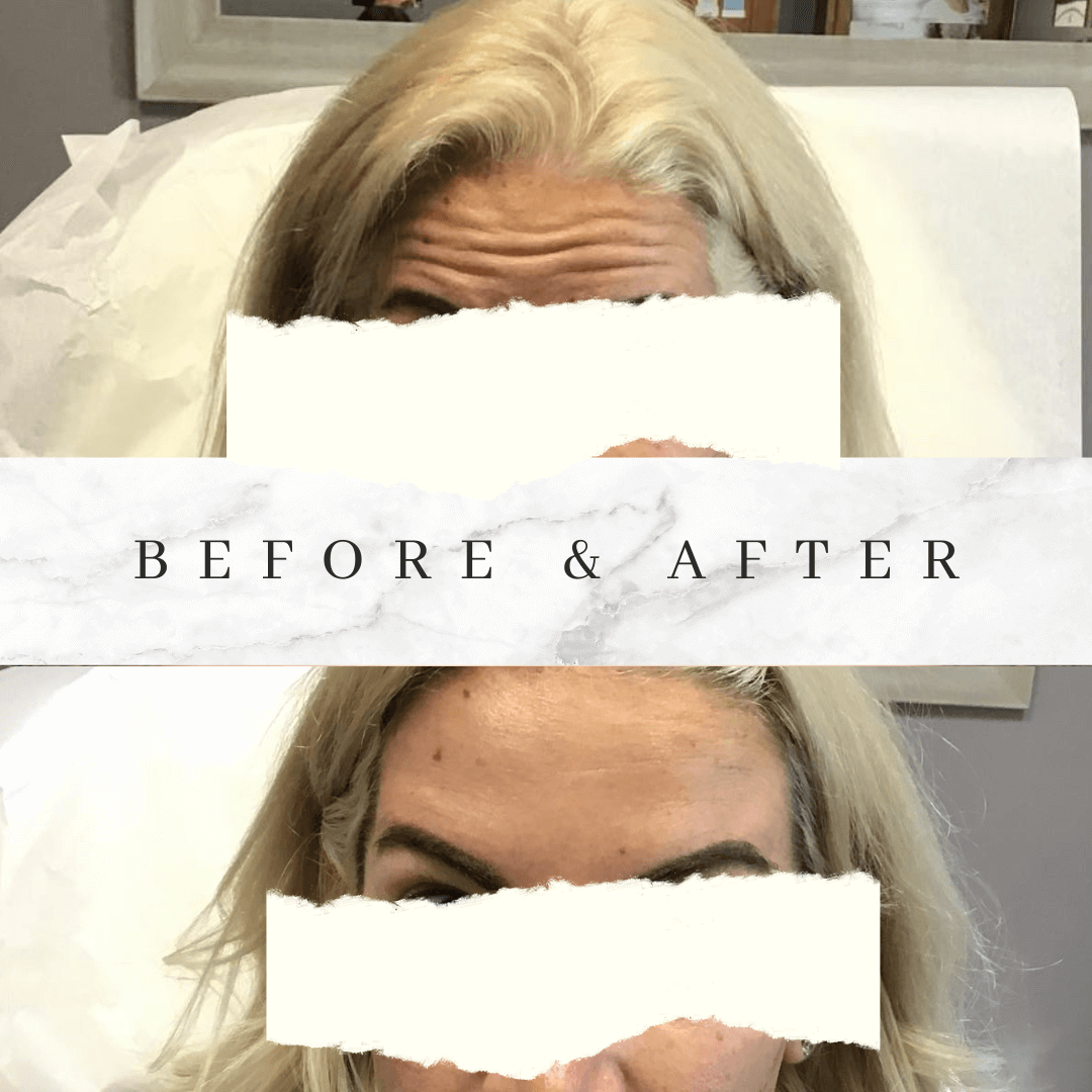 Botox Before and After Photo by Dr. Frankel in Manasquan, NJ