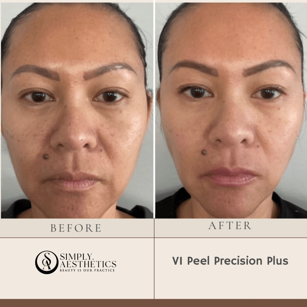 VI Peel Precision Plus Before and After Photo by Dr. Frankel in Manasquan, NJ