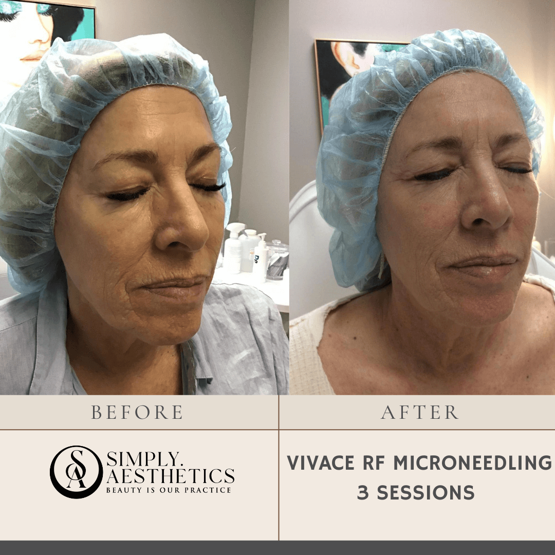 VIVACE RF MICRONEEDLING 3 SESSIONS