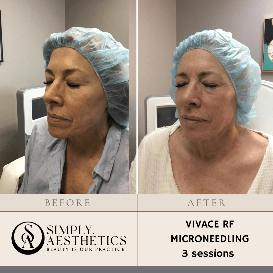 VIVACE RF MICRONEEDLING 3 sessions