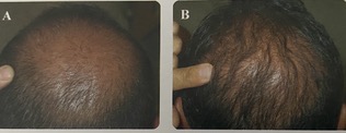 Hair Restoration Before and After Photo by Dr. Frankel in Manasquan, NJ