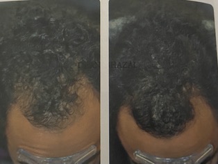 Hair Restoration Before and After Photo by Dr. Frankel in Manasquan, NJ