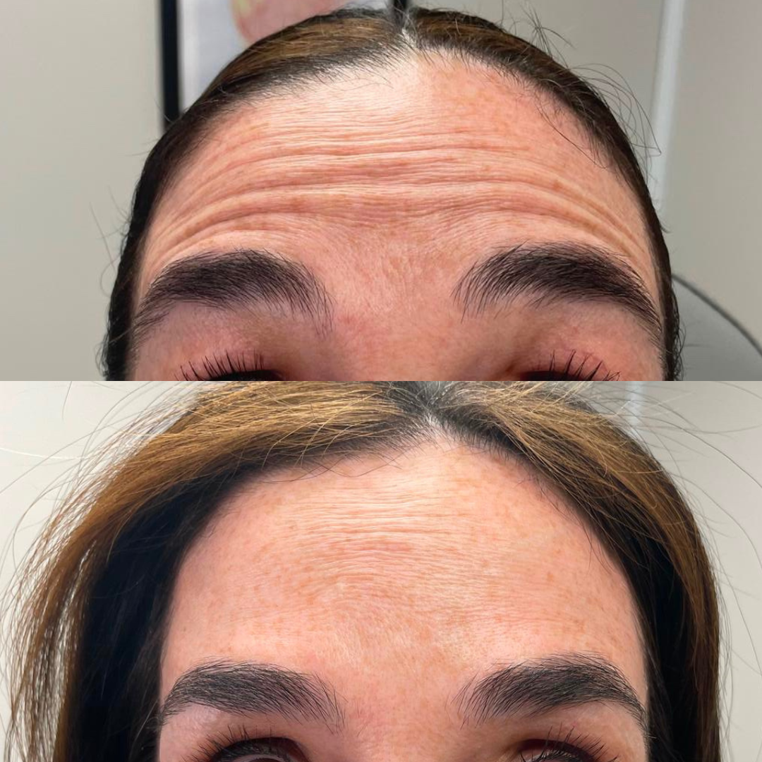 Botox Before and After Photo by Simply.Aesthetics in Manasquan NJ