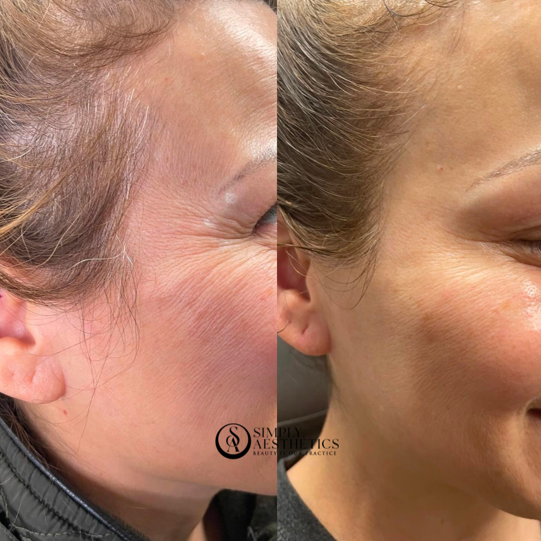 Botox Before and After Photo by Simply.Aesthetics in Manasquan NJ8