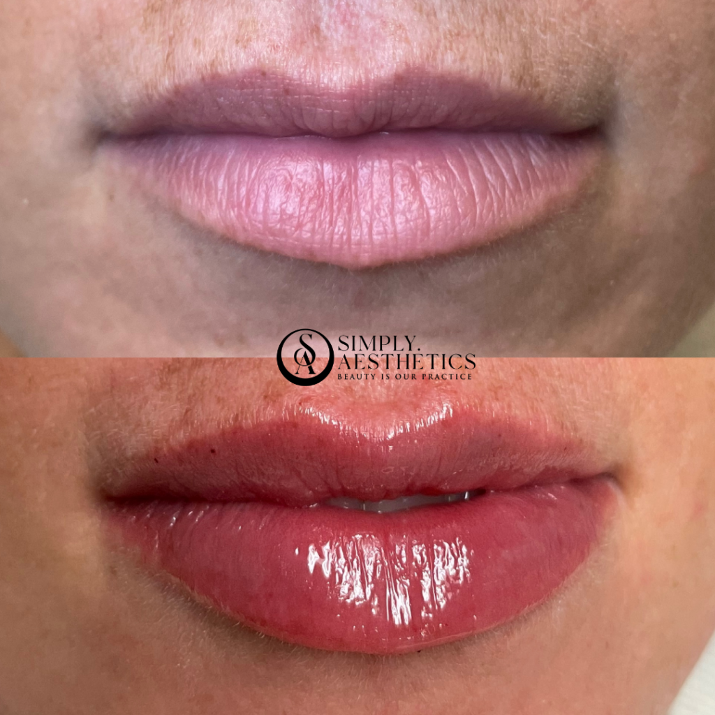 Lip Filler Before and After Photo by Simply.Aesthetics in Manasquan NJ
