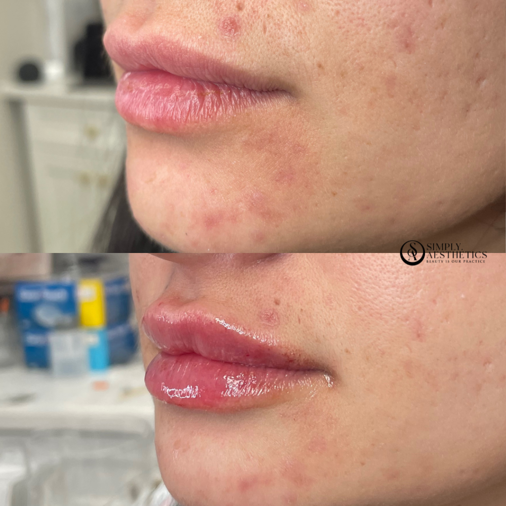 Lip Filler Before and After Photo by Simply.Aesthetics in Manasquan NJ