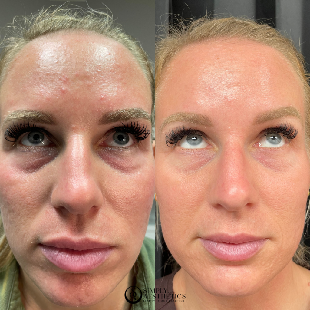 Viora Before and After Photo by Simply.Aesthetics in Manasquan NJ