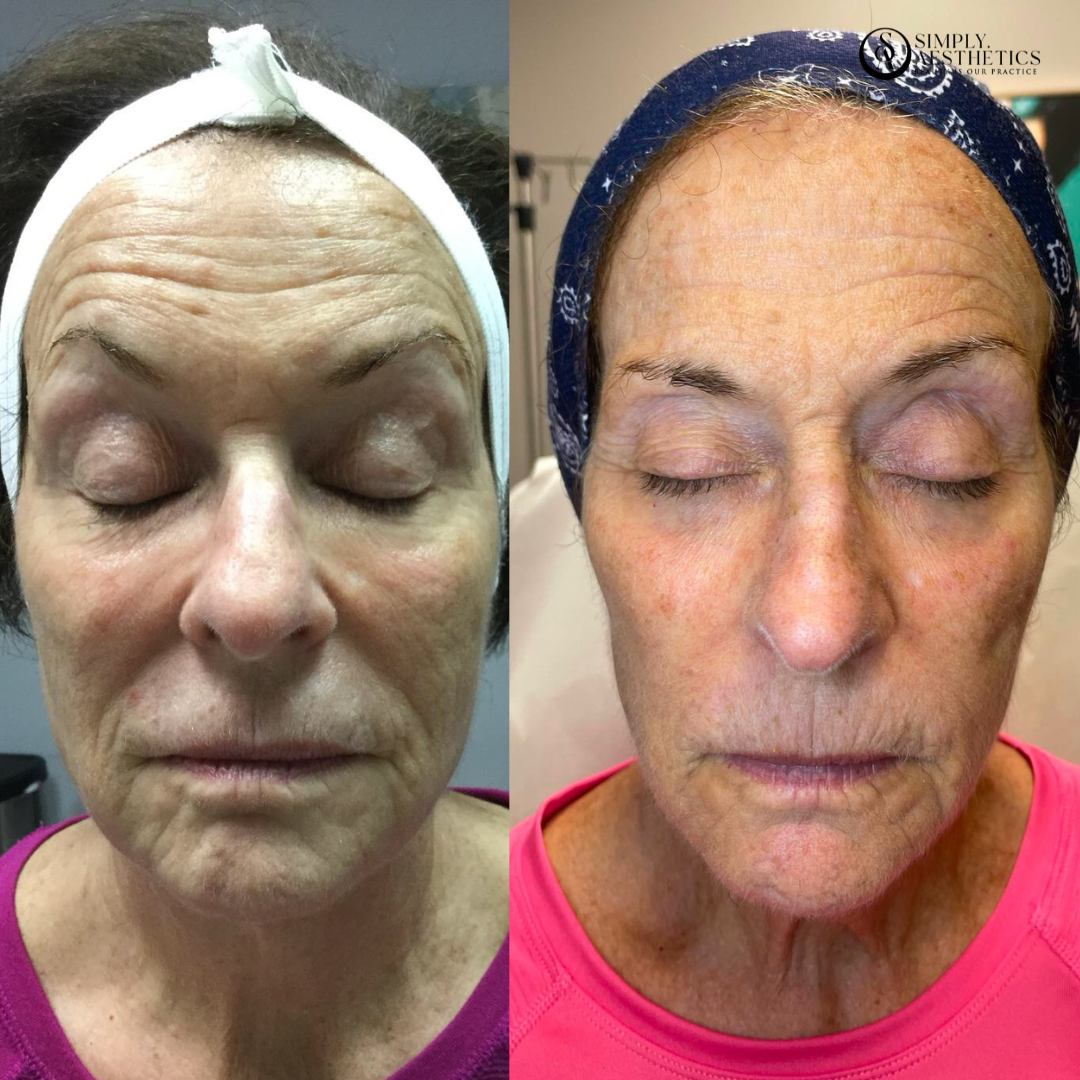 Vivace Before and After Photo by Simply.Aesthetics in Manasquan NJ