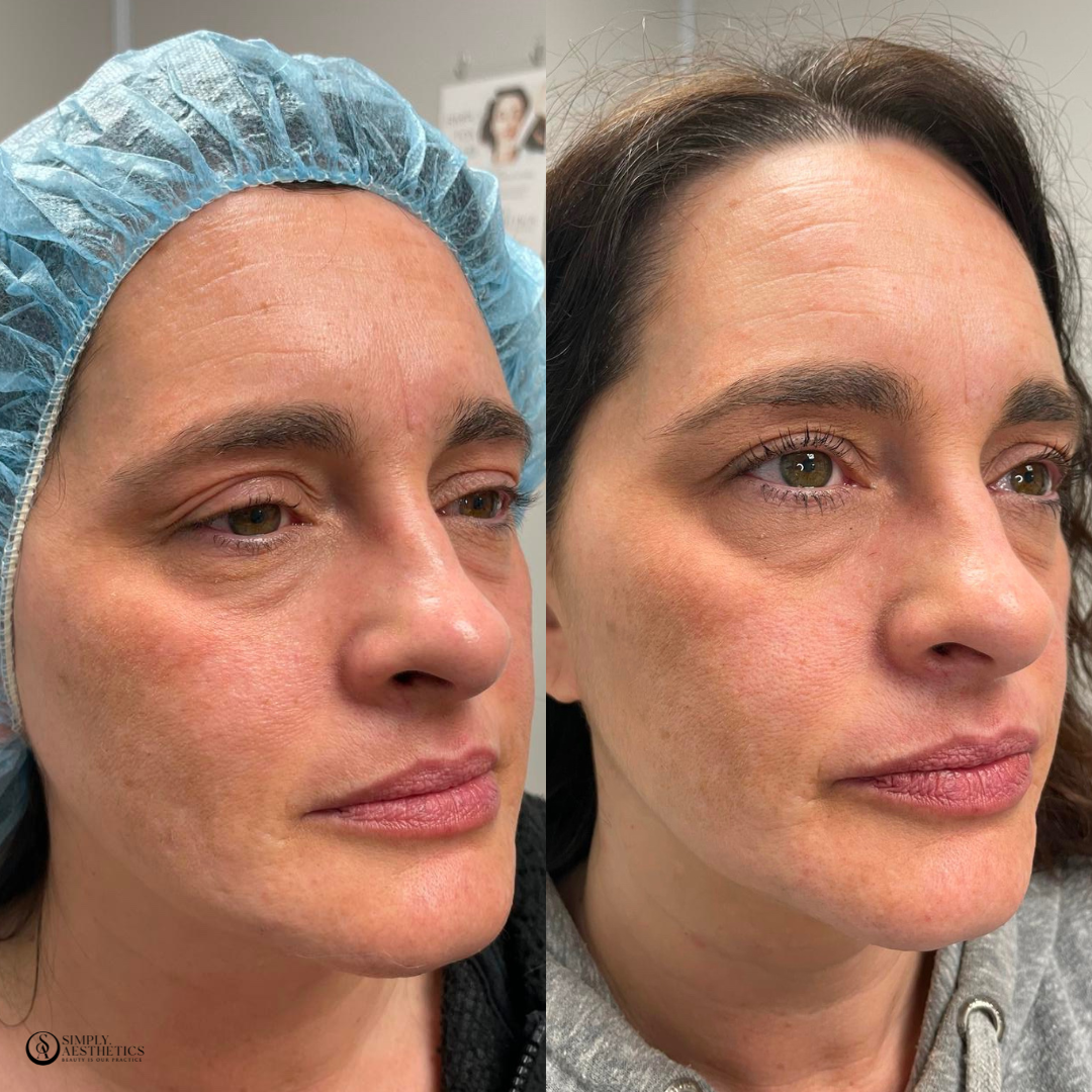 Vivace Before and After Photo by Simply.Aesthetics in Manasquan NJ