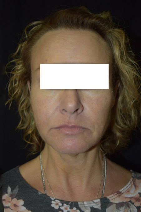 Dermal Fillers after photo by Simply.Aesthetics MedSpa in Point Pleasant, NJ