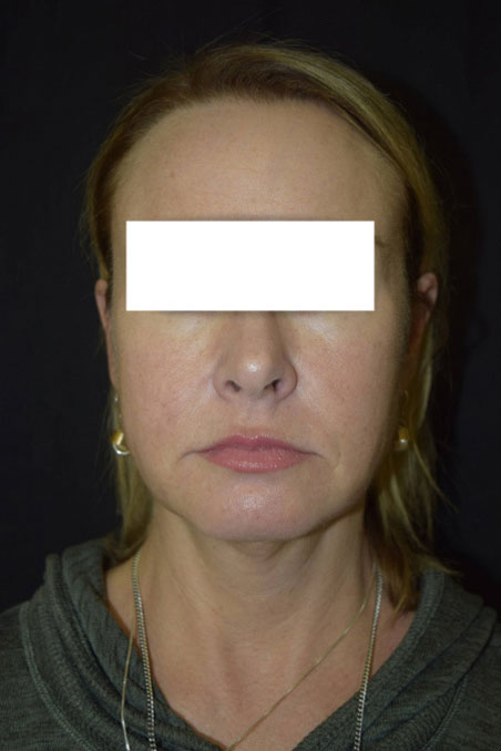 Dermal Fillers before photo by Simply.Aesthetics MedSpa in Point Pleasant, NJ