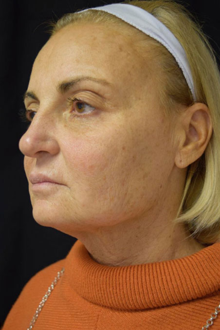 Dermal Fillers before photo by Simply.Aesthetics MedSpa in Point Pleasant, NJ